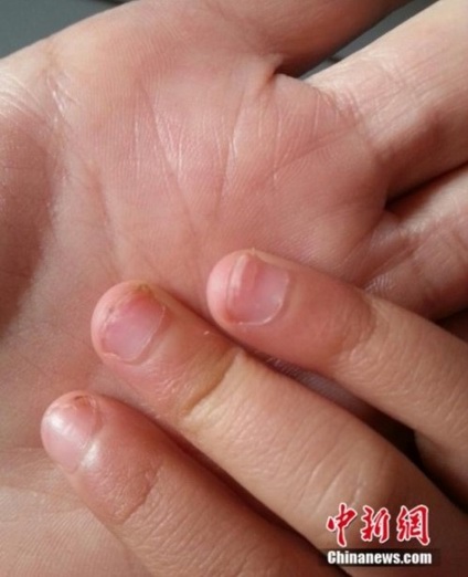 患病幼儿的手指甲出现明显的外翻症状